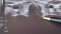 An endocrinologist analyzes an ultrasound of the thyroid gland