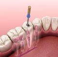 Endodontic root canal treatment process. Medically accurate tooth illustration Royalty Free Stock Photo