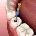 Endodontic root canal treatment process. Medically accurate tooth illustration