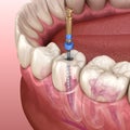 Endodontic root canal treatment process. Medically accurate tooth illustration