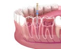 Endodontic root canal treatment process. Medically accurate tooth 3D illustration