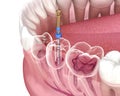 Endodontic root canal treatment process. Medically accurate tooth 3D illustration Royalty Free Stock Photo