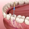 Endodontic root canal treatment process. Medically accurate tooth 3D illustration Royalty Free Stock Photo