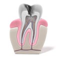 Endodontics - root canal procedure Royalty Free Stock Photo