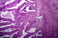 Endometrial adenocarcinoma, light micrograph