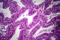 Endometrial adenocarcinoma, light micrograph