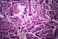 Endometrial adenocarcinoma, light micrograph