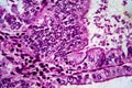 Endometrial adenocarcinoma, light micrograph