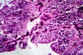 Endometrial adenocarcinoma, light micrograph
