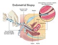 Endometrial biopsy procedure