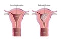 Endometrial cancer medical illustration