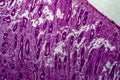 Endometrial hyperplasia, light micrograph Royalty Free Stock Photo