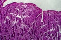 Endometrial hyperplasia, light micrograph Royalty Free Stock Photo