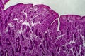 Endometrial hyperplasia, light micrograph