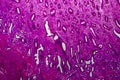 Endometrial hyperplasia, light micrograph Royalty Free Stock Photo
