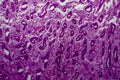 Endometrial hyperplasia, light micrograph Royalty Free Stock Photo