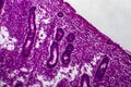 Endometrial hyperplasia, light micrograph Royalty Free Stock Photo