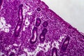 Endometrial hyperplasia, light micrograph