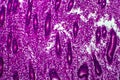 Endometrial hyperplasia, light micrograph Royalty Free Stock Photo