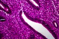 Endometrial hyperplasia, light micrograph Royalty Free Stock Photo