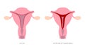 Endometrial hyperplasia in uterus medical illustration. Precancerous condition of female endometrium.