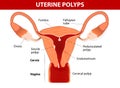 Endometrial polyp or uterine polyp Royalty Free Stock Photo