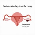 Endometrioid cyst on the ovary. Endometriosis. . Infographics. Vector illustration