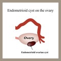 Endometrioid cyst on the ovary. Endometriosis. Ovary.