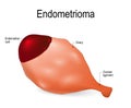 Endometrioma. endometrial cyst