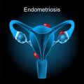 Endometriosis. Cross section of a human uterus