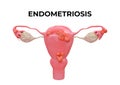 Endometriosis is a disease characterized by the presence of endometrium outside the uterine cavity and in other organs