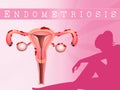 Endometriosis Royalty Free Stock Photo