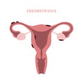 endometriosis info graphic womens health uterus anatomy Royalty Free Stock Photo