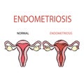 ENDOMETRIOSIS NORMAL FEMALE Reproductive System Education