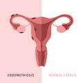 endometriosis and normal uterus womens health anatomy info graphic Royalty Free Stock Photo