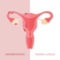 endometriosis and normal uterus womens health anatomy info graphic Royalty Free Stock Photo
