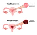 Endometriosis. The structure of the pelvic organs. Adenomyosis. The endometrium. Vector illustration