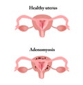 Endometriosis. The structure of the pelvic organs. Adenomyosis. The endometrium. Vector illustration