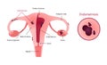 Endometriosis of uterus involves ovaries, fallopian tubes and cervix. Endometriosis close up. Womb witj vagina and ovary