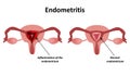 Endometritis. Inflammation of the endometrium. Inflammation of the uterus. Infographics Vector illustration on