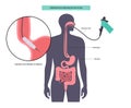 Endoscopic pneumatic dilation