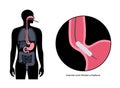 Endoscopic pneumatic dilation