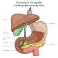 Endoscopic retrograde cholangiopancreatography