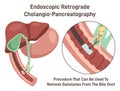 Endoscopic retrograde cholangiopancreatography. ERCP, bile duct diagnosis. Royalty Free Stock Photo