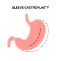 Endoscopic sleeve gastroplasty