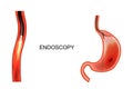 Endoscopy of the stomach. EGD. ulcer, cancer