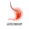 Endoscopy. The stomach of a person with gastritis. Gastroenterology. Vector illustration in a flat style.