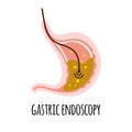 Endoscopy. The stomach of a person with high acidity. Gastroenterology. Vector illustration in a flat style.