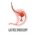 Endoscopy. The stomach of a person with an ulcer. Gastroenterology. Vector illustration in a flat style.