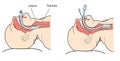 Endotracheal tube